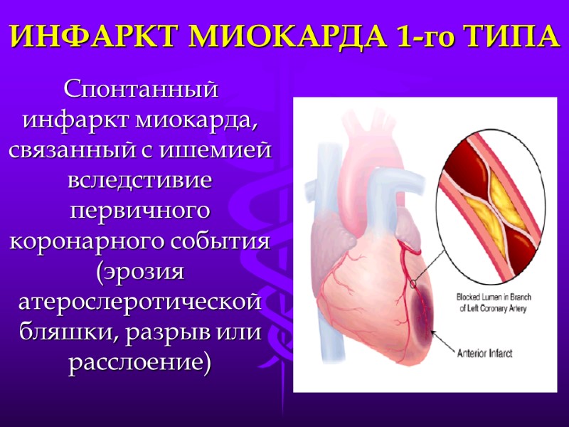 ИНФАРКТ МИОКАРДА 1-го ТИПА Спонтанный инфаркт миокарда, связанный с ишемией вследстивие первичного коронарного события